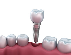 A 3D illustration shows a dental implant being placed into a gap in the gum where a tooth is missing, between two natural teeth. The implant consists of a screw and a crown.