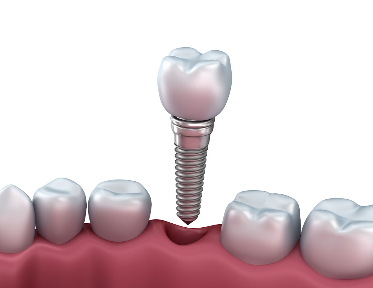 A 3D illustration shows a dental implant being placed into a gap in the gum where a tooth is missing, between two natural teeth. The implant consists of a screw and a crown.